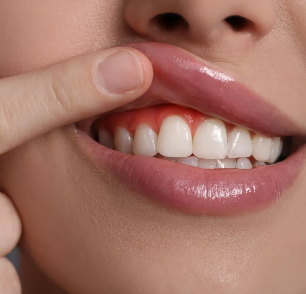 Diş Eti Estetiği Tedavisi - 1