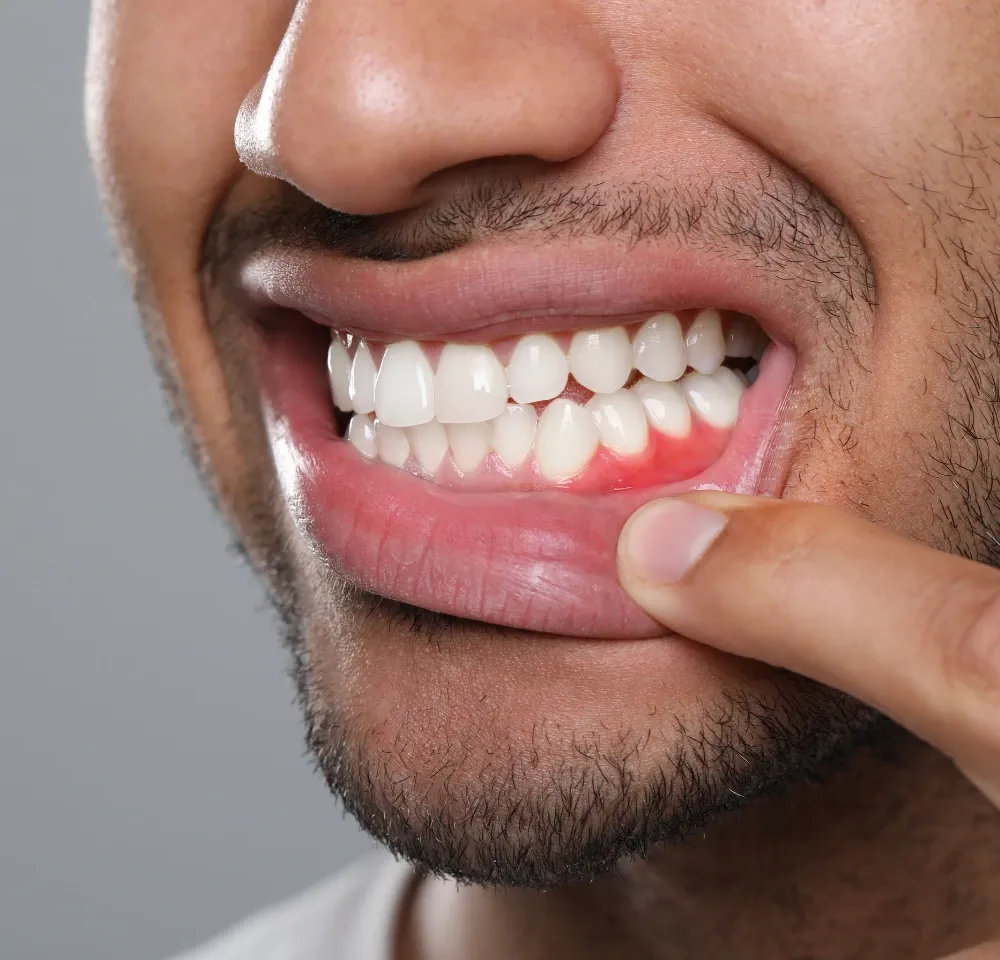 Diş Eti Hastalıkları - 1